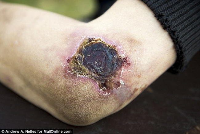 Krokodil Elbow Flesh