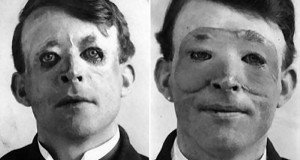 First Plastic Surgery Og