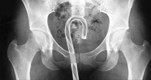 Candy Cane Funny X-Ray Images
