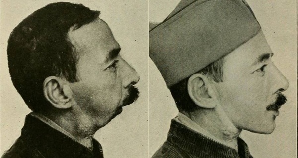 Man Missing Jaw Comparison