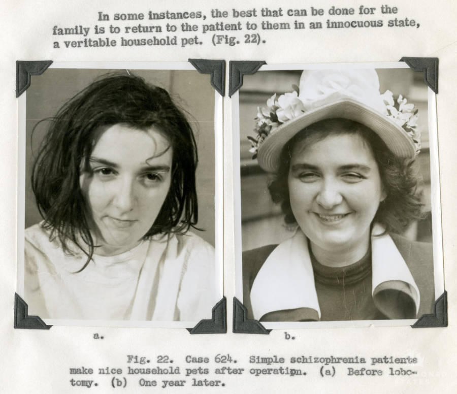 Schizophrenia Patient Before And After A Lobotomy