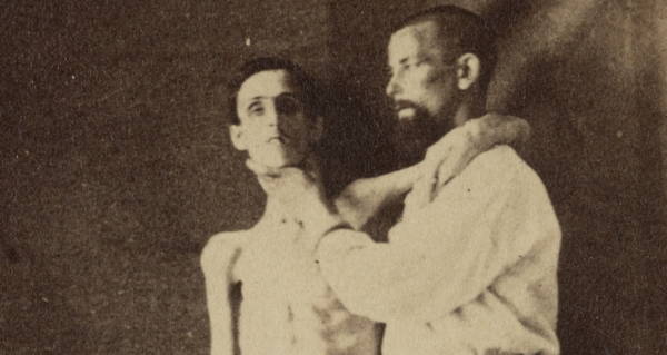 Starved Andersonville Prisoner