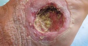 Maggot Therapy