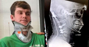Brock Meister X Ray