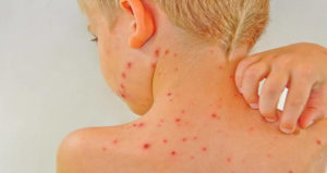 Baby Chickenpox Og1