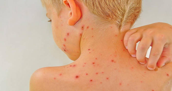 Baby Chickenpox Og1