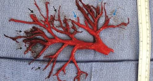 Blood Clot Inset