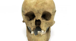 Cleft Palate Featured