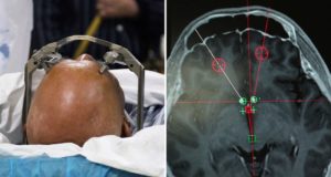 Patient Yan During DBS Surgery Featured