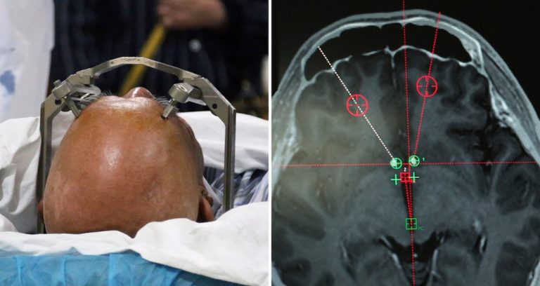 Patient Yan During DBS Surgery Featured