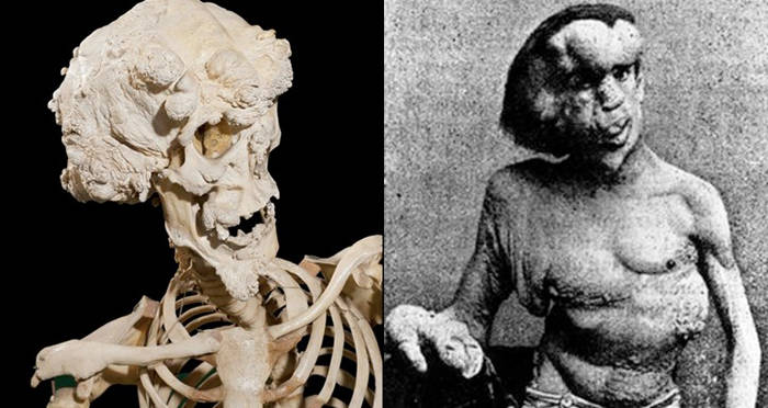 Skeleton And Head Of Elephant Man