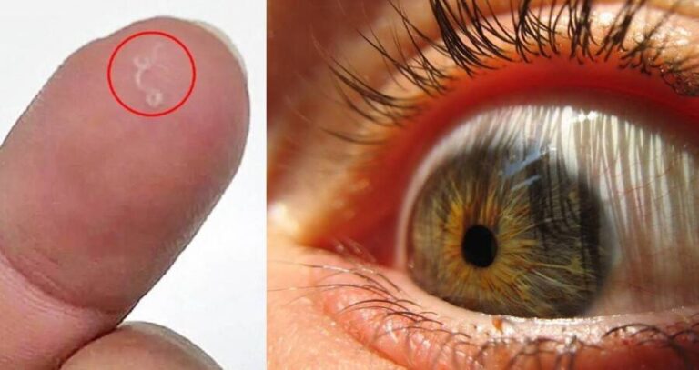 Parasitic Eye Worms Og