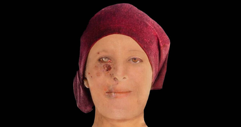 Scottish Leprosy Victim