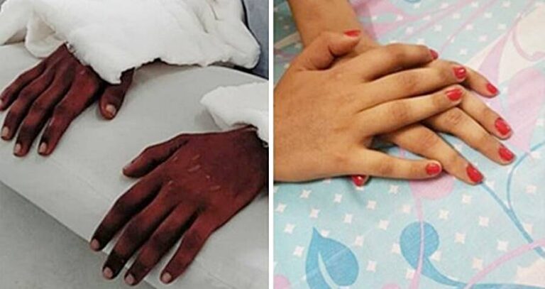 Changing Skin Hand Transplant