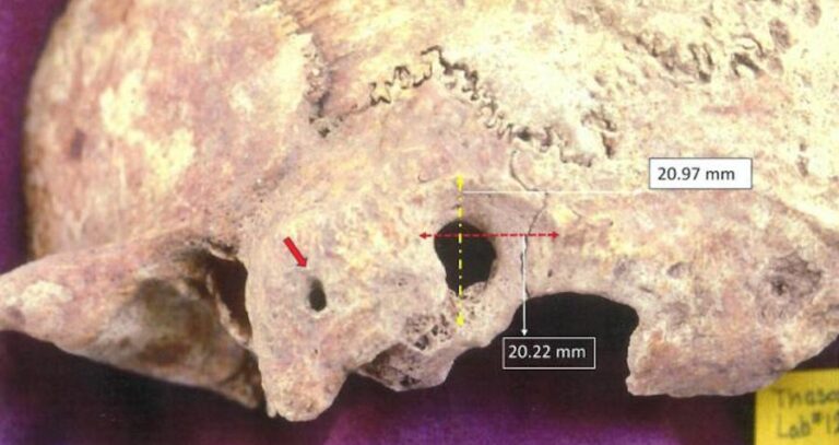 Ancient Greek Skull Post Surgery