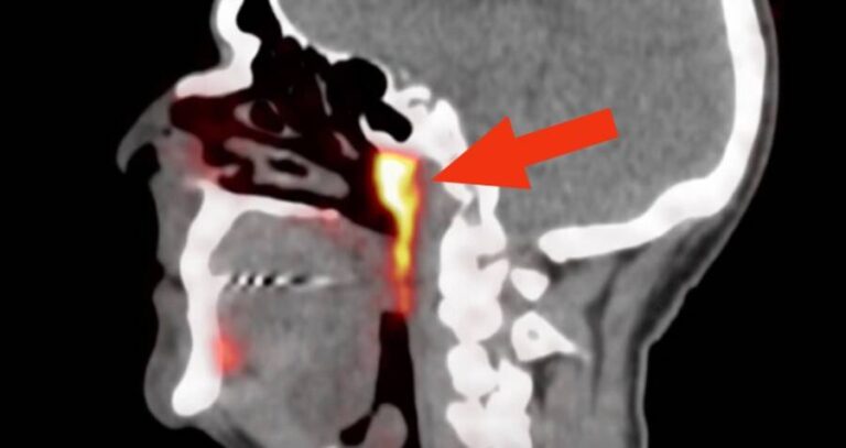 X Ray Showing New Gland