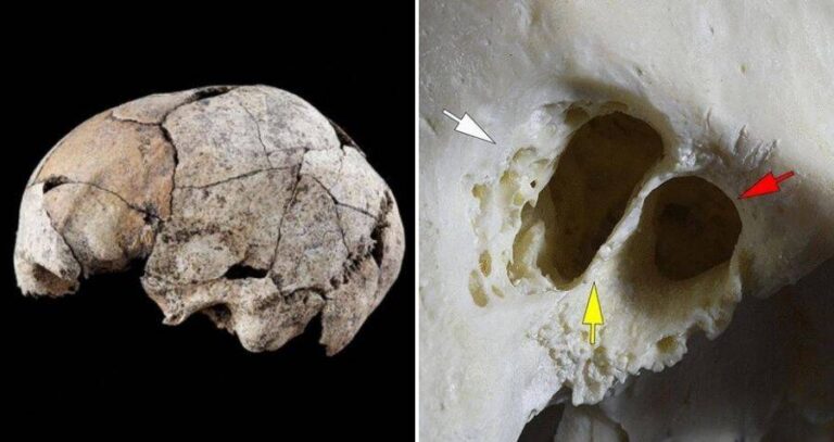 Earliest Ear Surgery Skull And Close Up