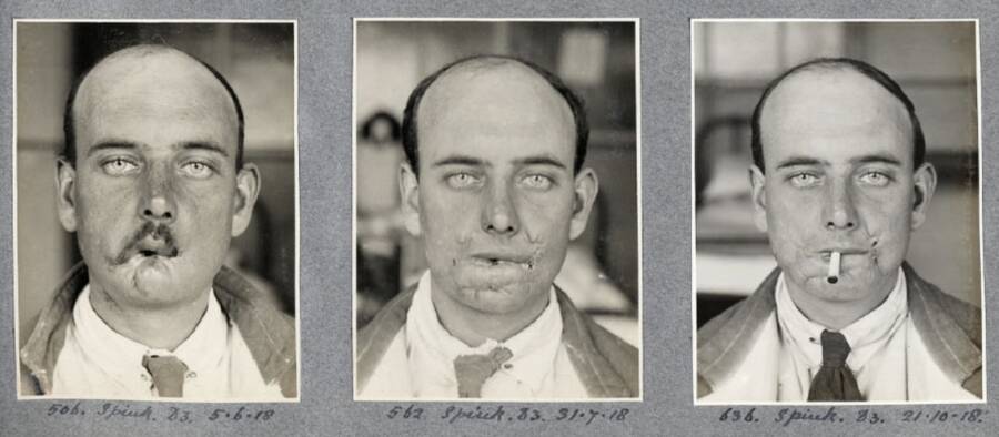 Patient Of Harold Gillies